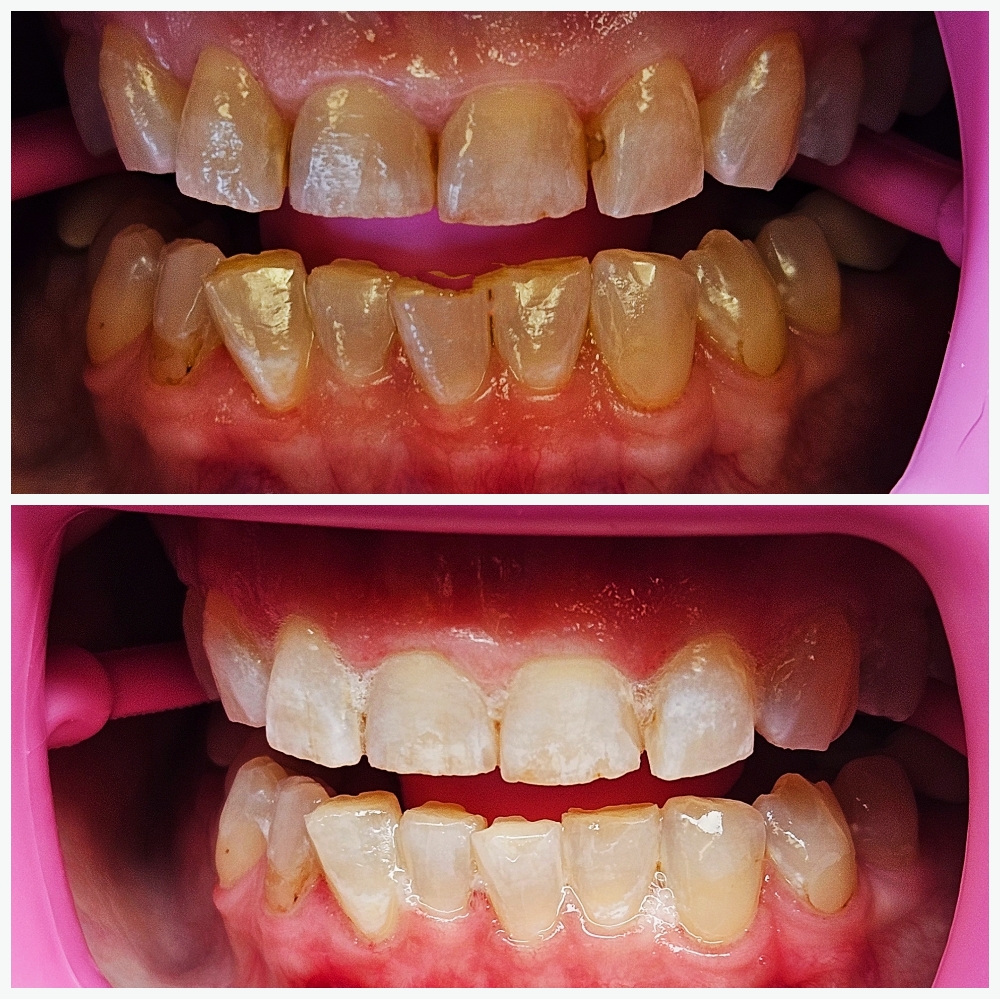 Instant Teeth Whitening Session