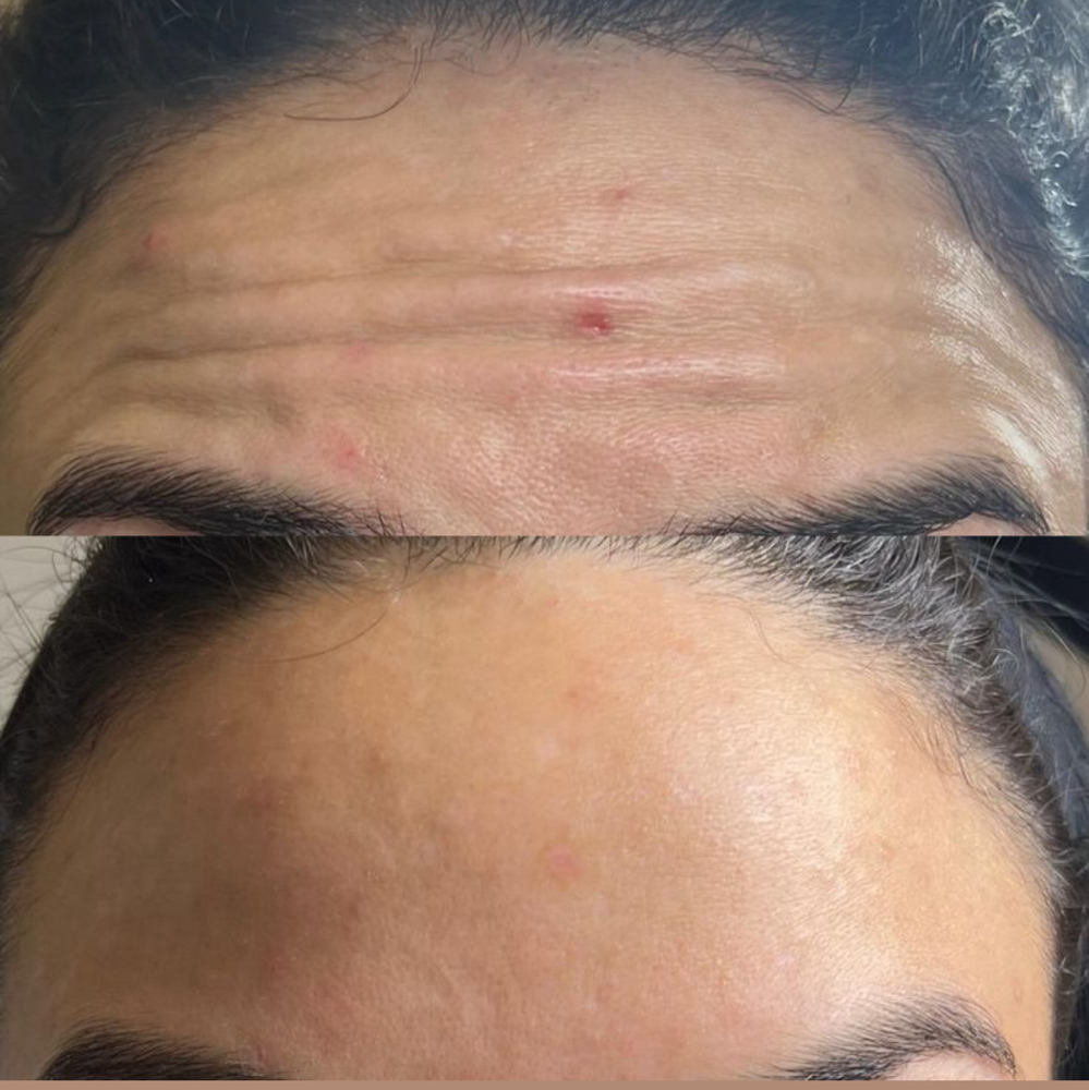 Glowtox: Forehead & Frown