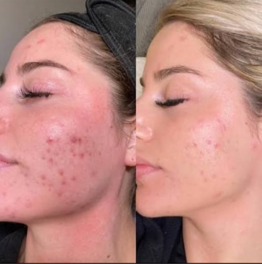 The Acne Edit (PD-13 Therapy)