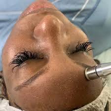 Microdermabrasion Facial
