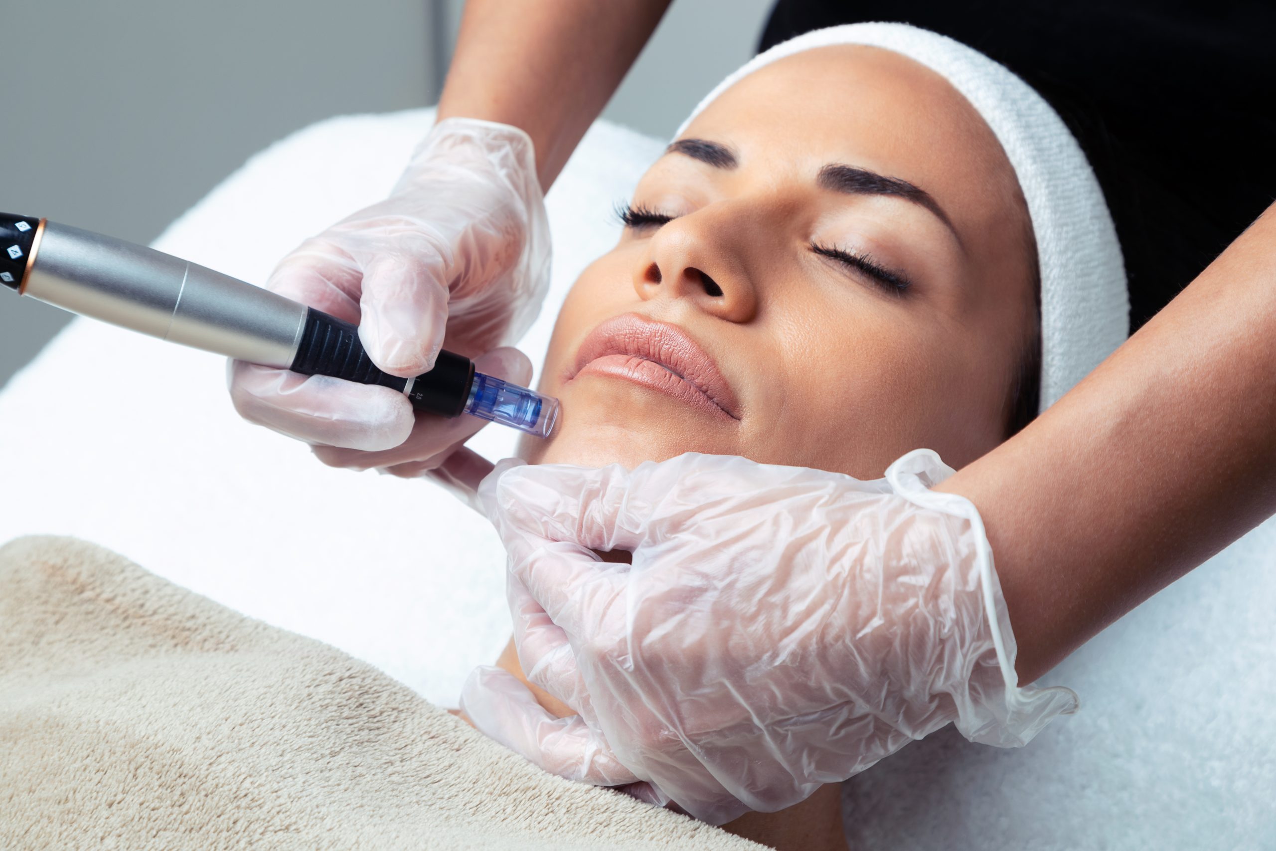 Microneedling Face
