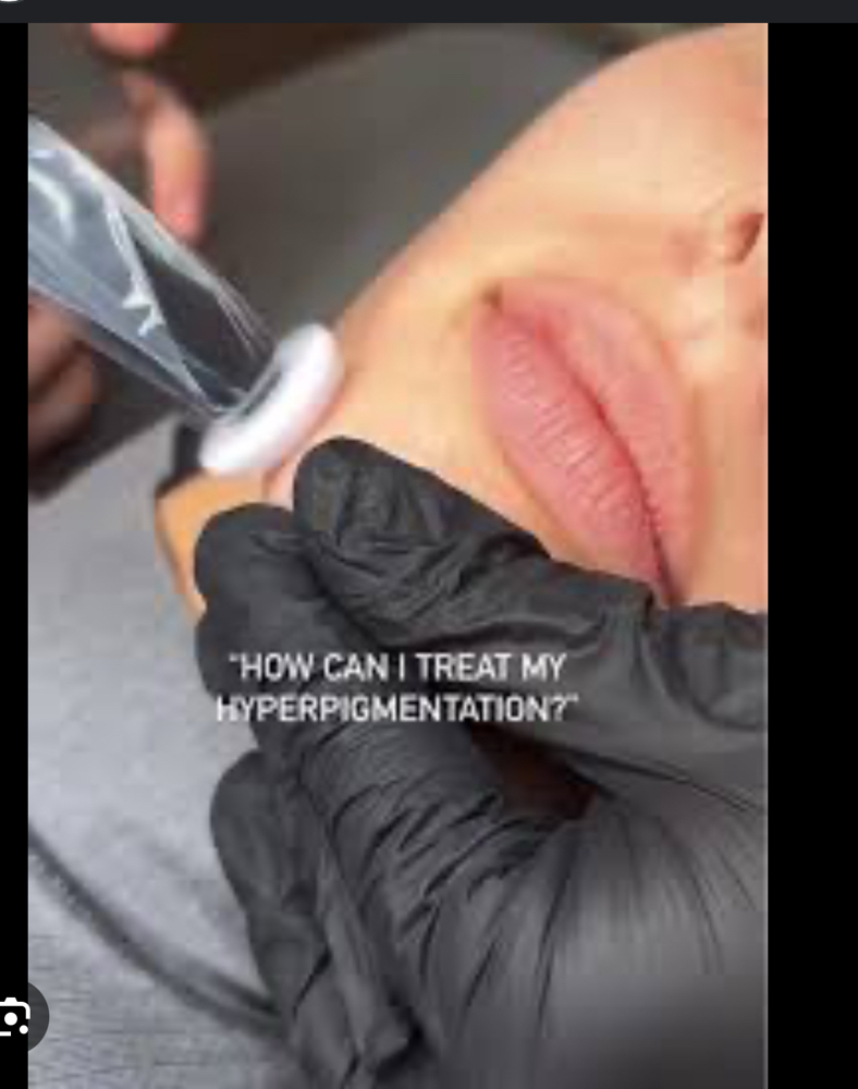 Microchanelling Lips
