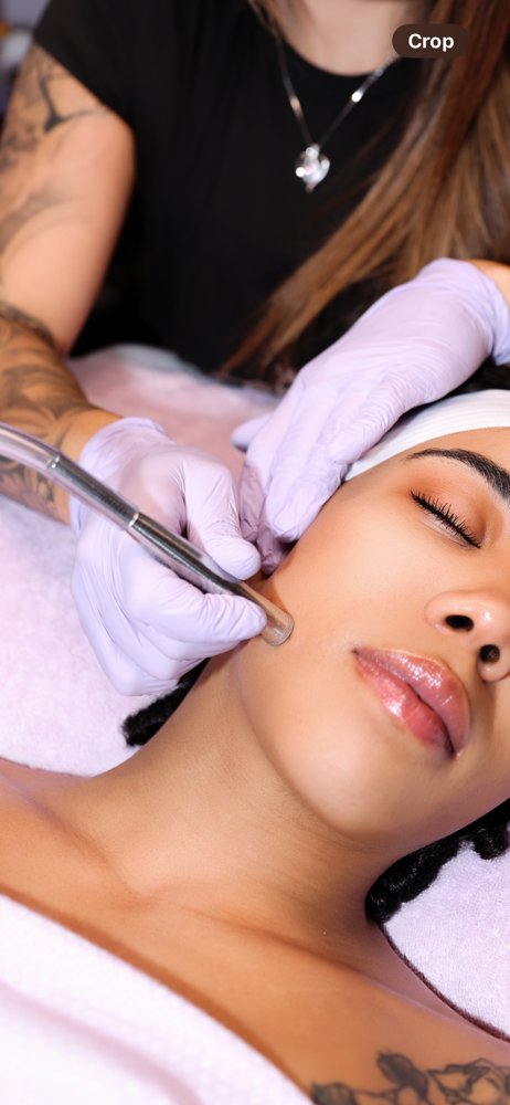 Microdermabrasion