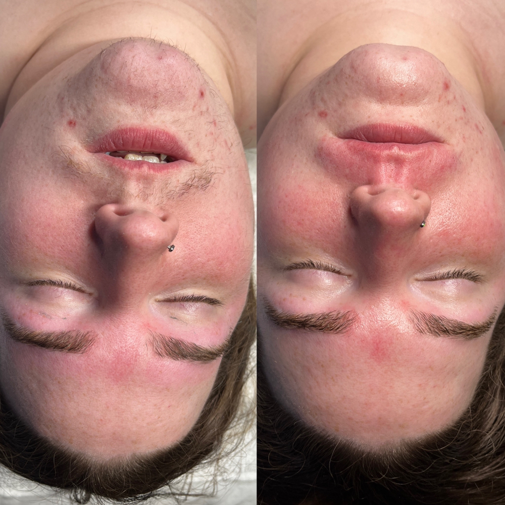 Dermaplane Facial