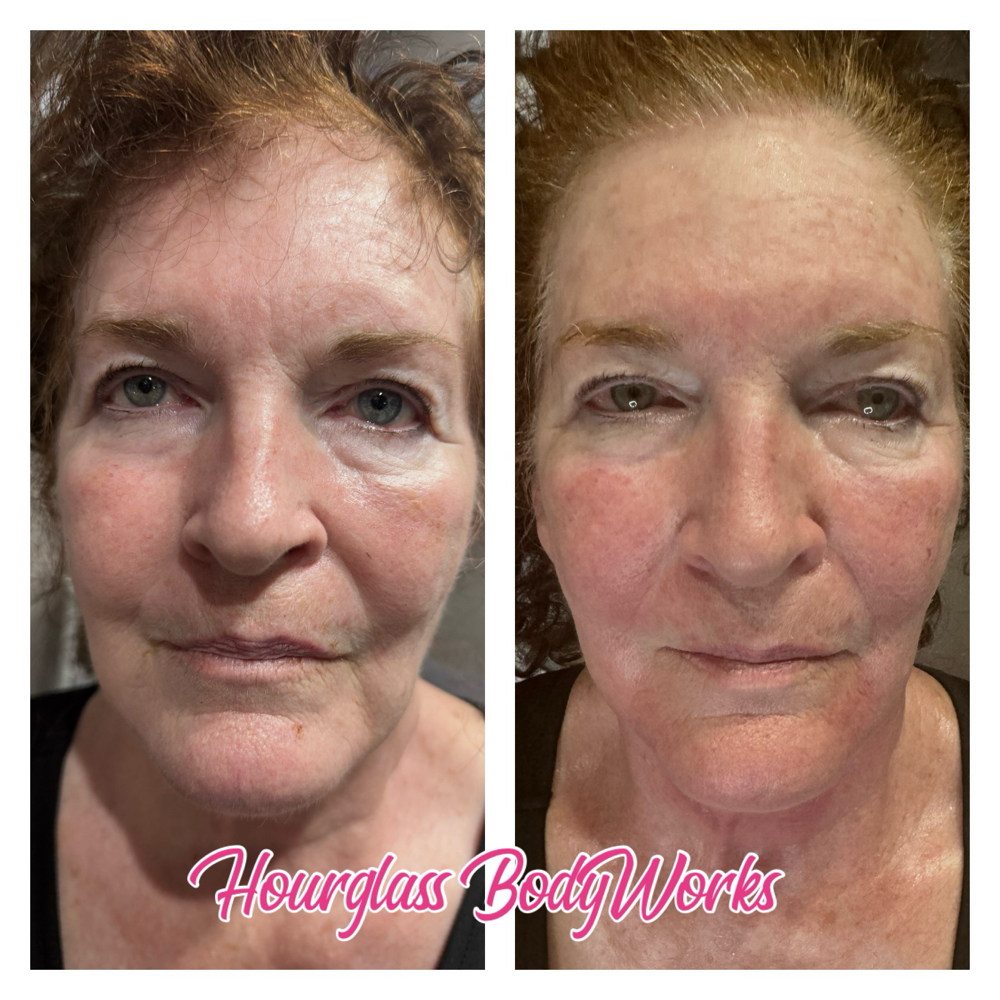 Radio Frequency Facelift