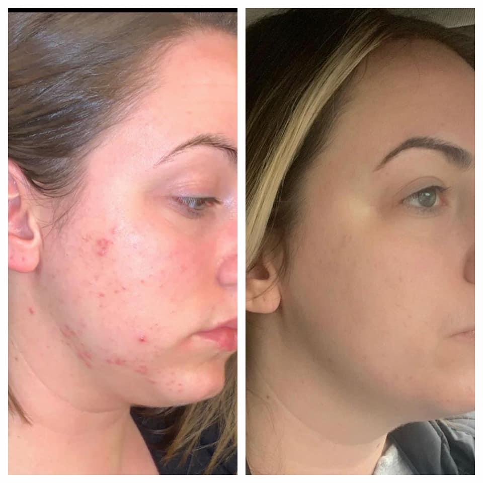 CUSTOMIZED CHEMICAL PEEL