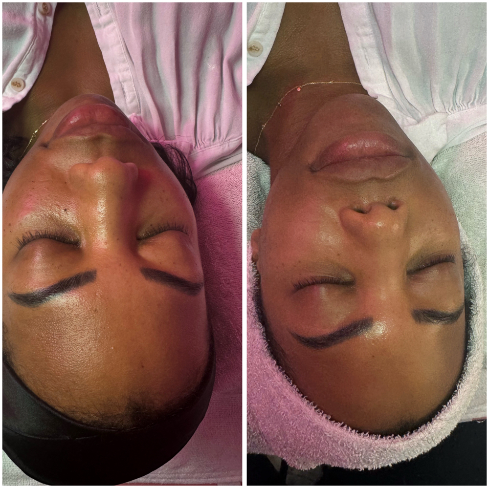 Microneedling + Stem Cell Repair