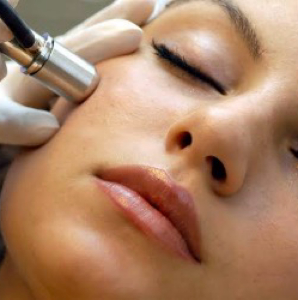 Microdermabrasion - Face at AW Skin & Balance in Royal Palm Beach, FL