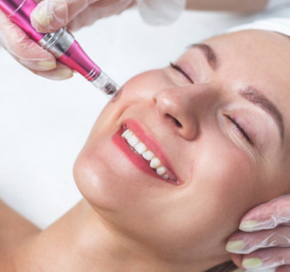 Microneedling