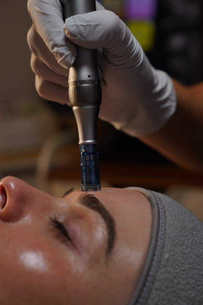 Microneedling