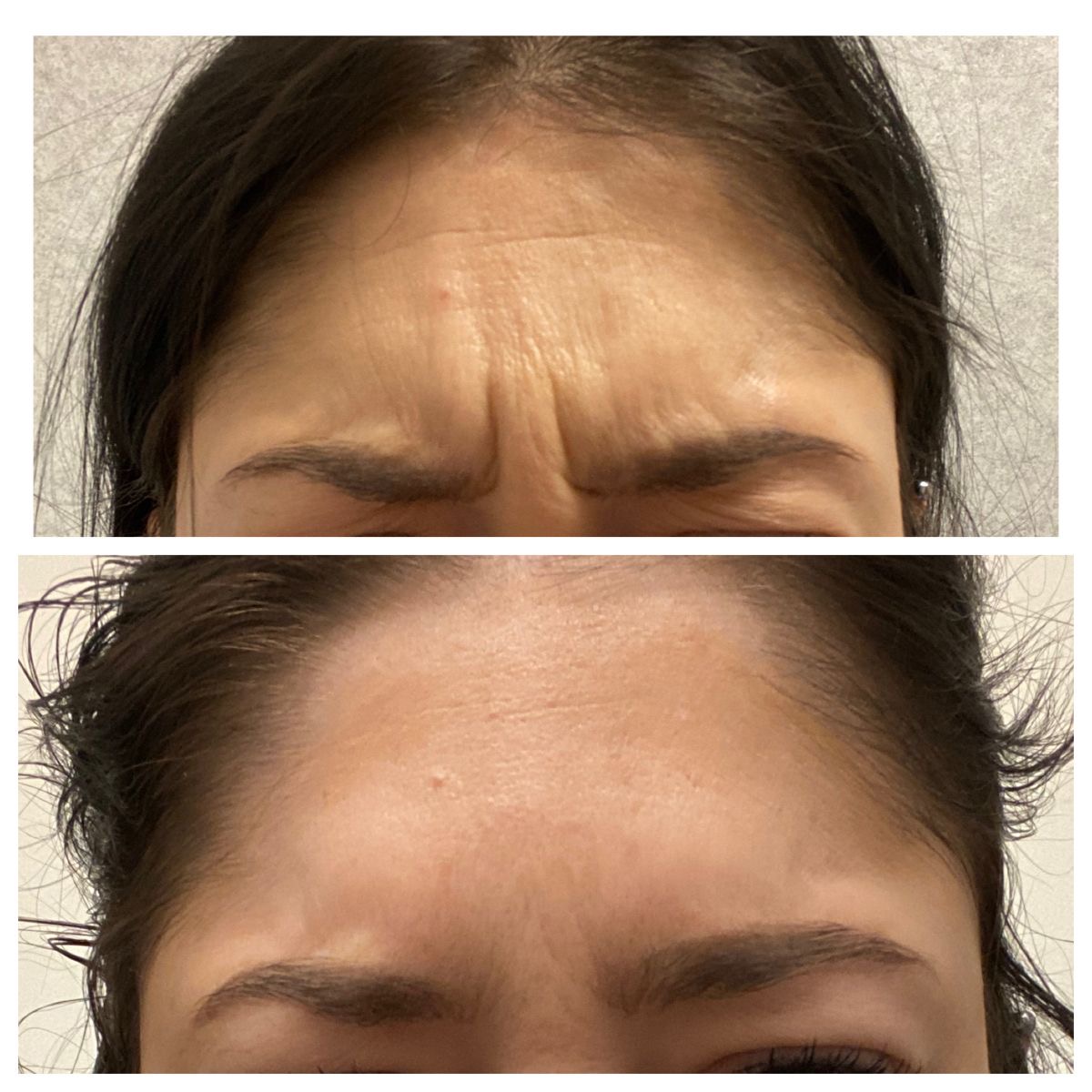 Glabella Complex