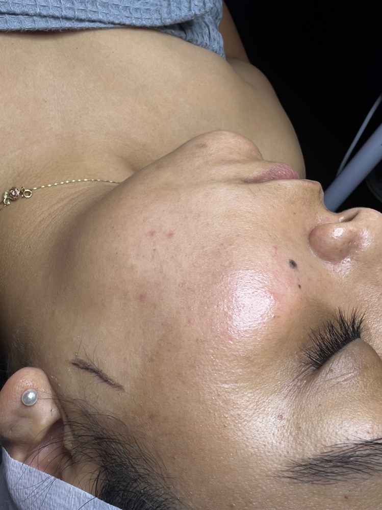 Dermaplaining Facial at Lv Snatched Beauty Bar in Las Vegas, NV