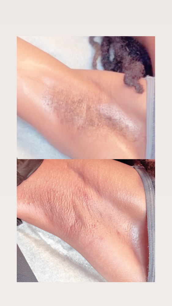 Underarm