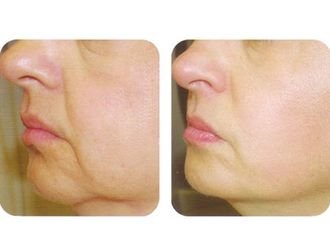 Facial Anti-aging