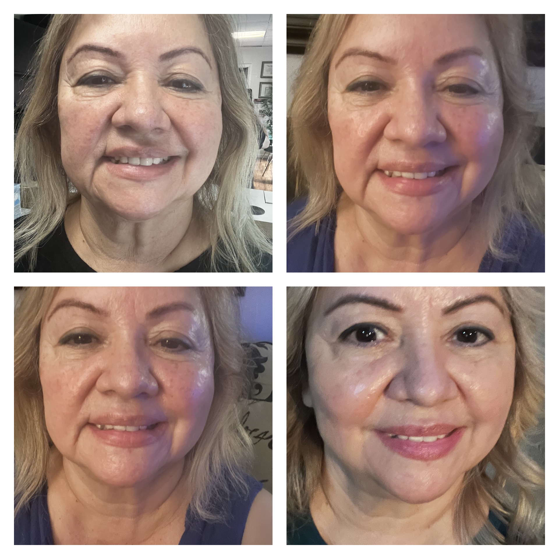 Facial Anti-aging with Neo Filler