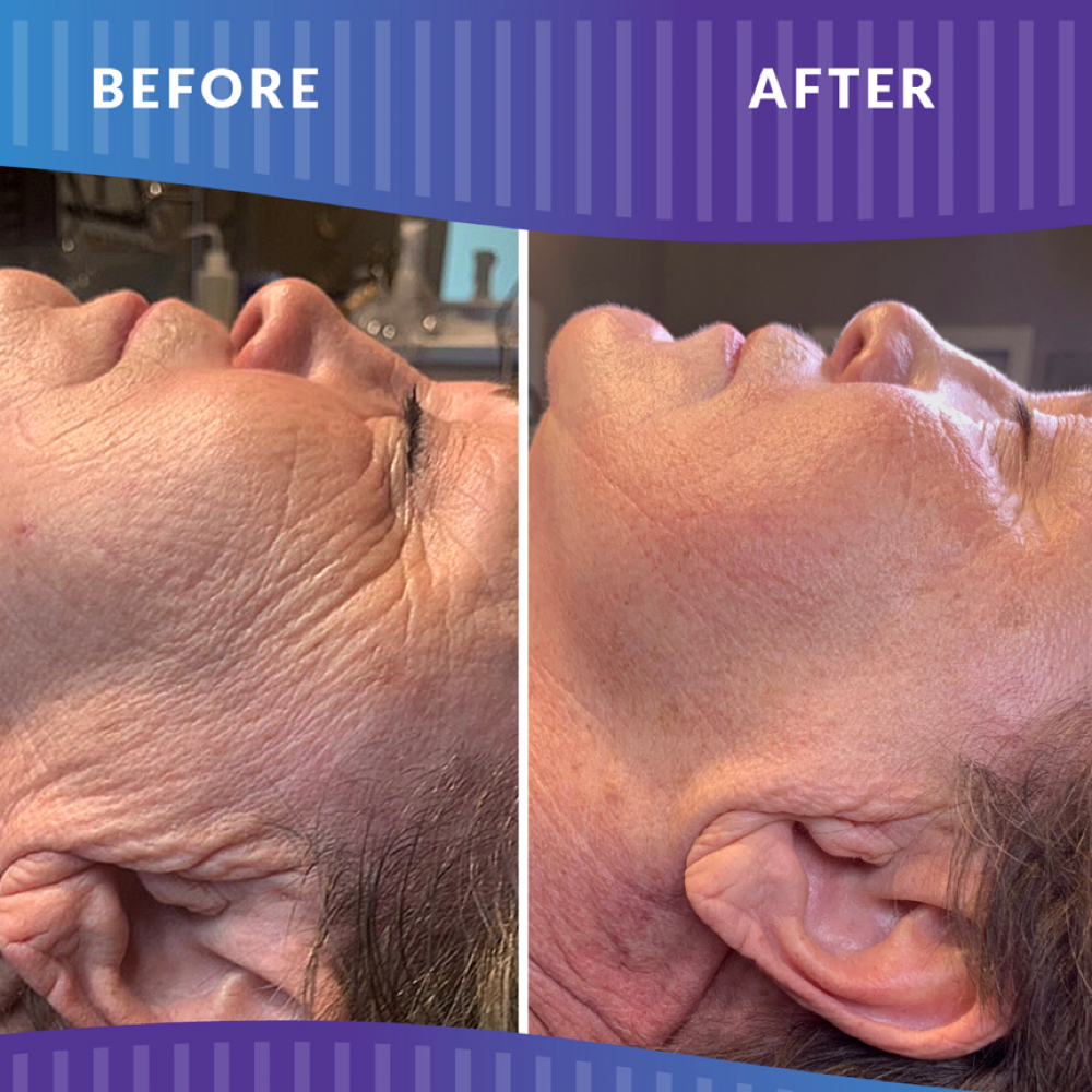 Pro Cell Microchanneling Therapy at NEYTIV in NY 11935, NY