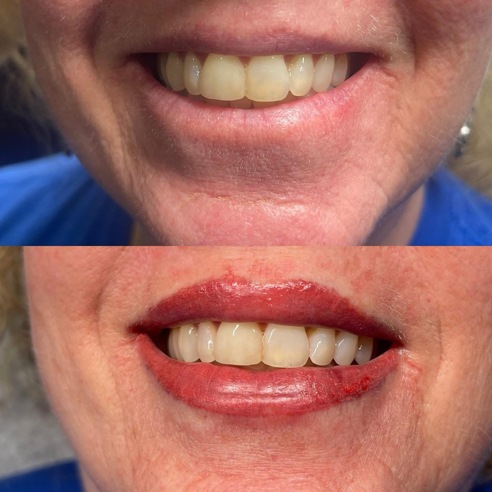 Lip Blush Follow Up