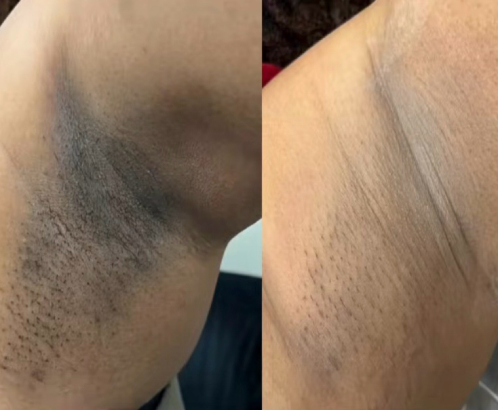 Intimate Brightening Treatment