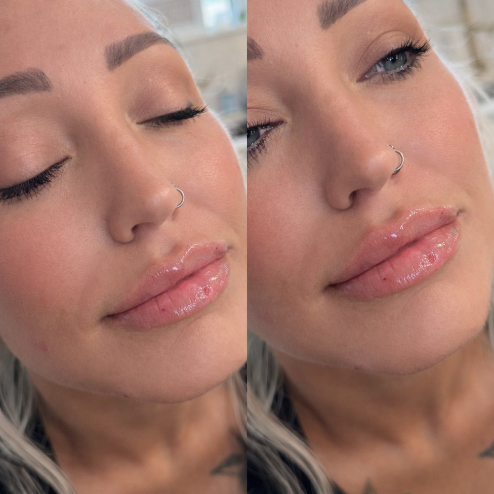 Model Lips 1/2 Syringe at Aesthetic Beauty Bar, LLC By Haley in Tyler, TX