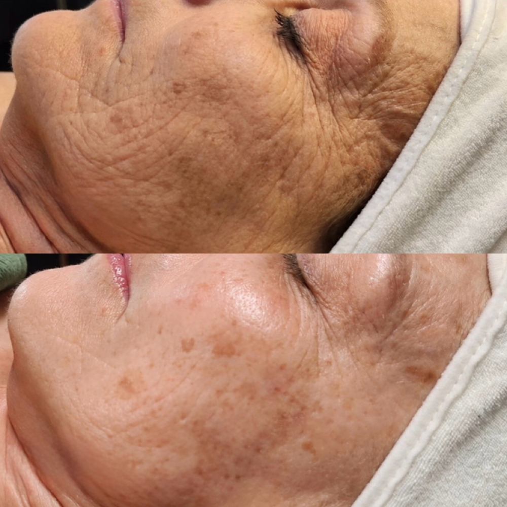 SWiCH Treatment at Salt + Light Skincare in Atascocita, TX
