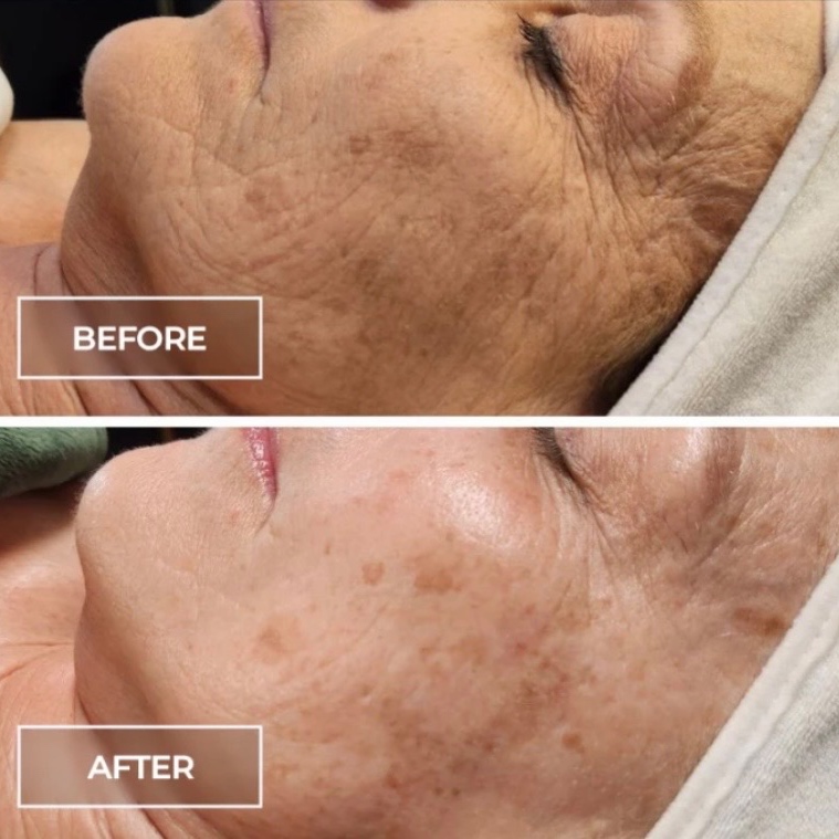 SWiCH Treatment at Salt + Light Skincare in Atascocita, TX