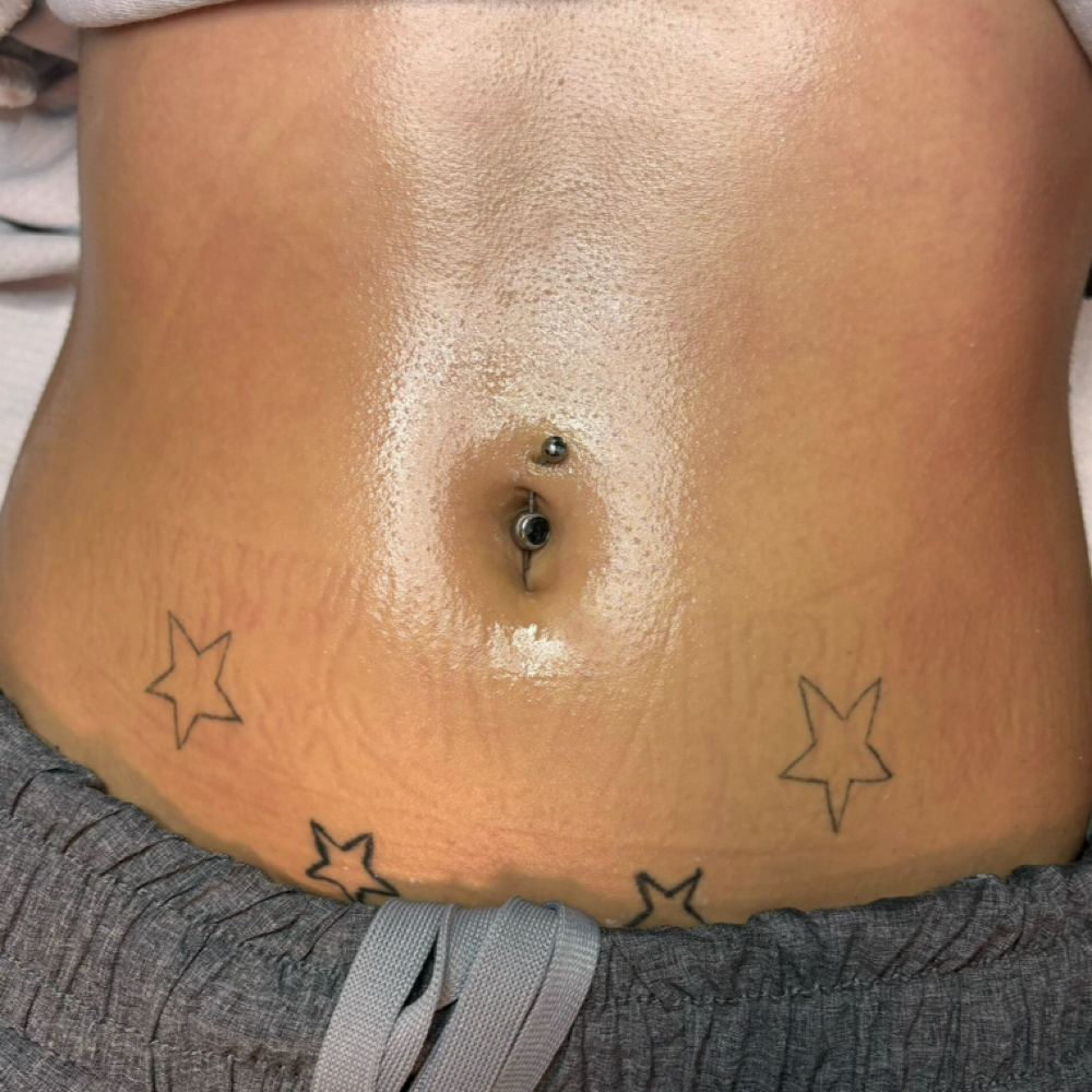 Full Stomach Wax at Pearly Derm in Sun valley, CA