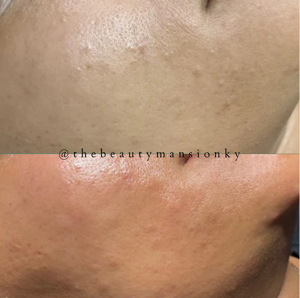 Deep Pore Cleanse treatment