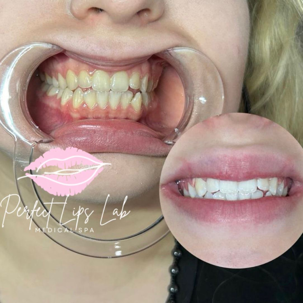 Blanqueamiento Dental