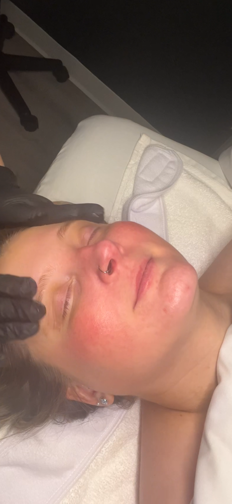 Chemical Peel Add-on