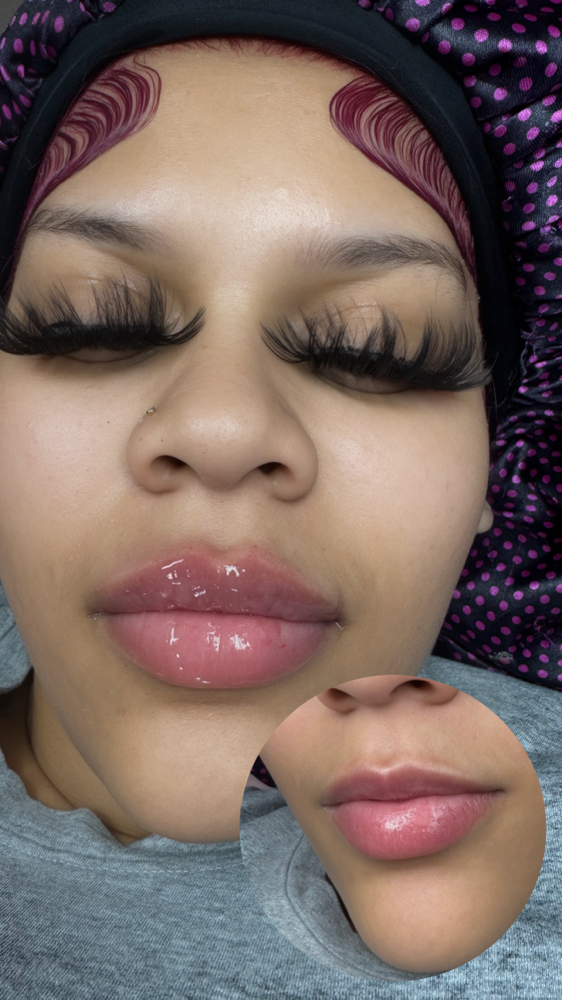 No Needle Injection 1.1ml