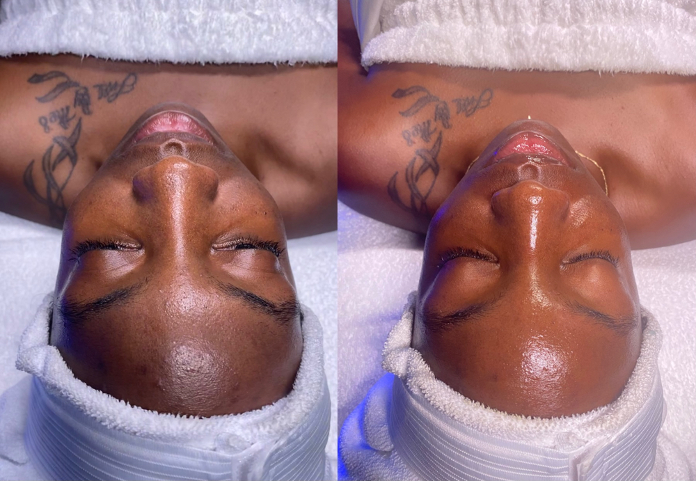 Brightening HydraFacial at Beauty Therapy by Chanel in Tucker, GA