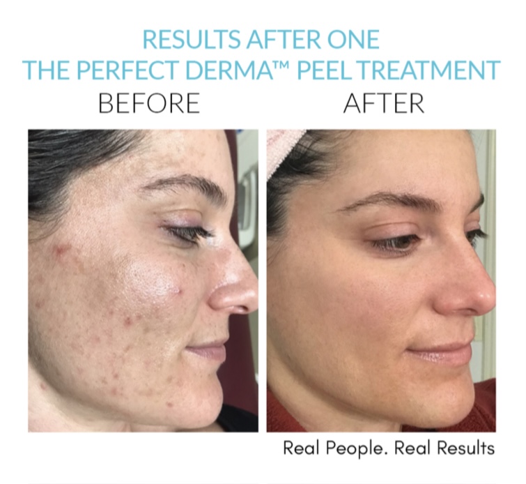 The Perfect Derma Peel