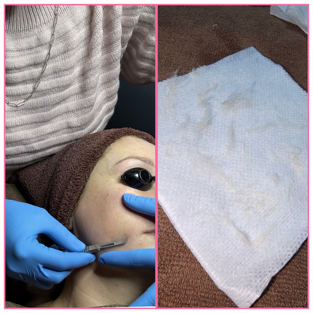 Dermaplaning