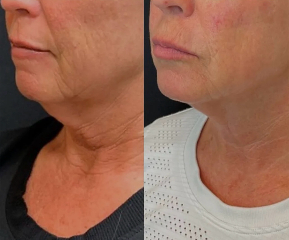 Microneedling Neck