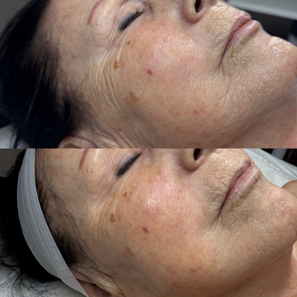 Firming Peptide Treatment - Add On at Esthetics by Molly in Mission Viejo, CA
