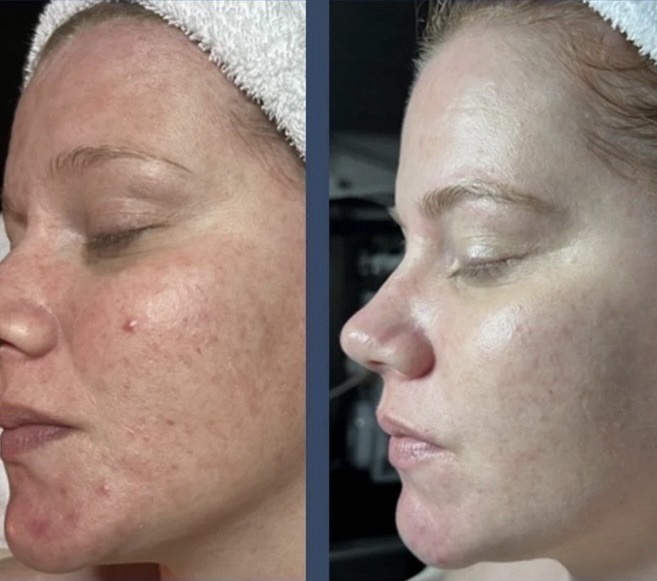 Calming Signature facial at Jane Rozier Permanent Makeup & Esthetics in La Vista, NE