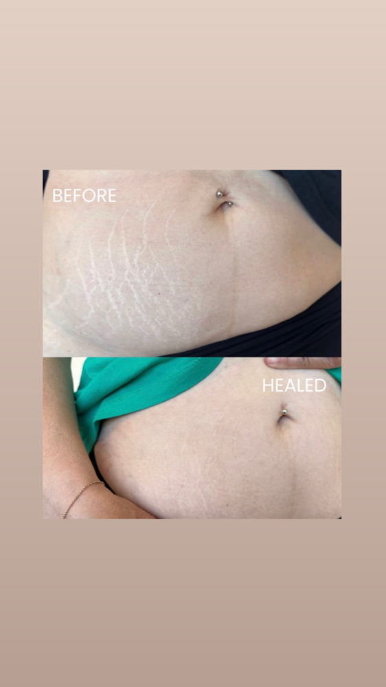 Stretch Mark Revision at THE BEAUTY SLANGER in Hacienda Heights, CA