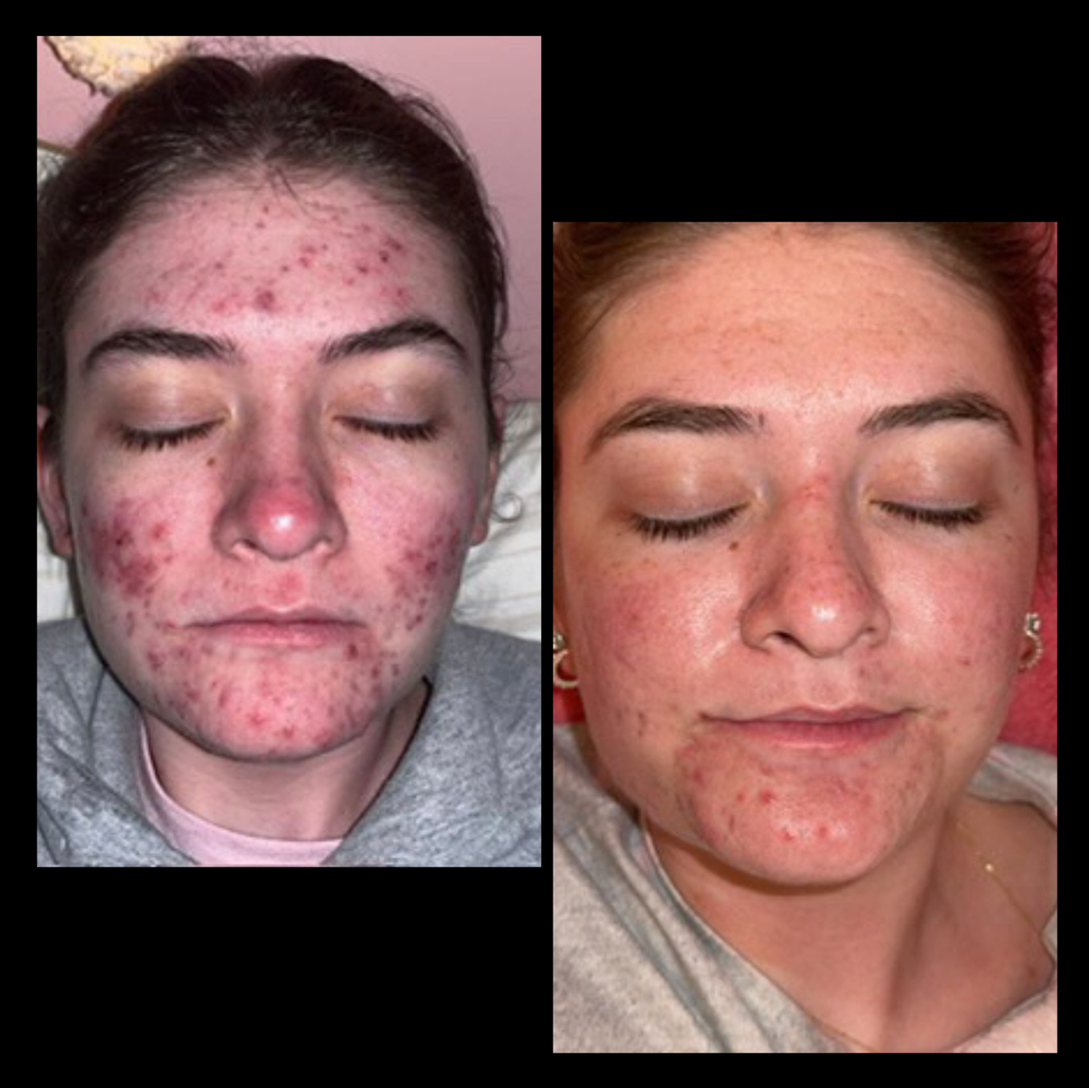 Acne Solutions Facial
