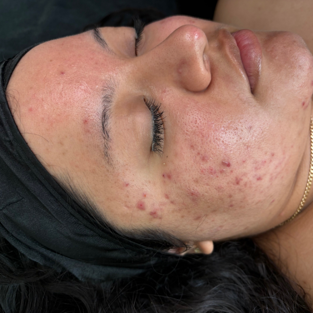 Skin Series Acne Bootcamp at Urban Soul and Skin in Balch Springs, TX