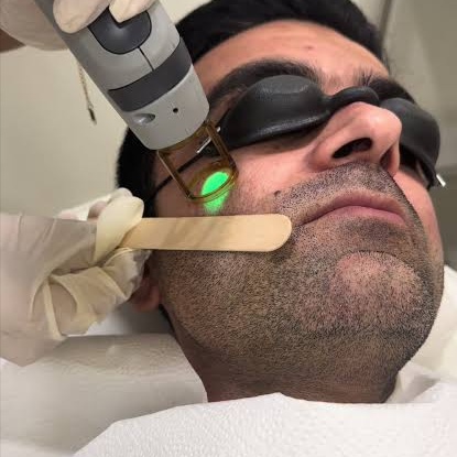 Face / Neck at Illumina Aesthetics and Laser in Palm Beach Gardens, FL