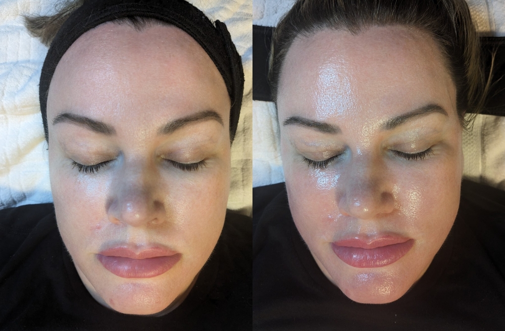 Advanced Chemical Peel