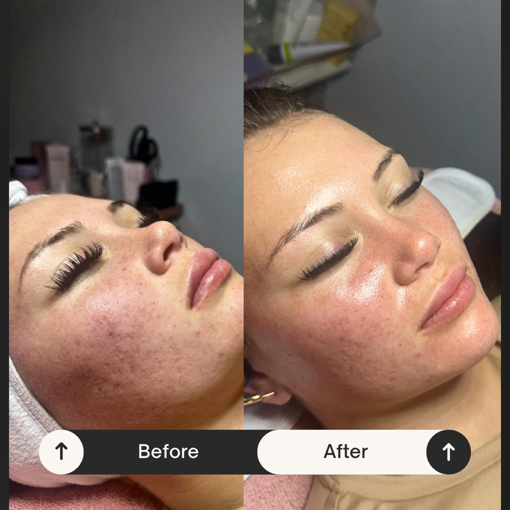 Dermaplane Facial at Fluttering Faces in Woodward, OK