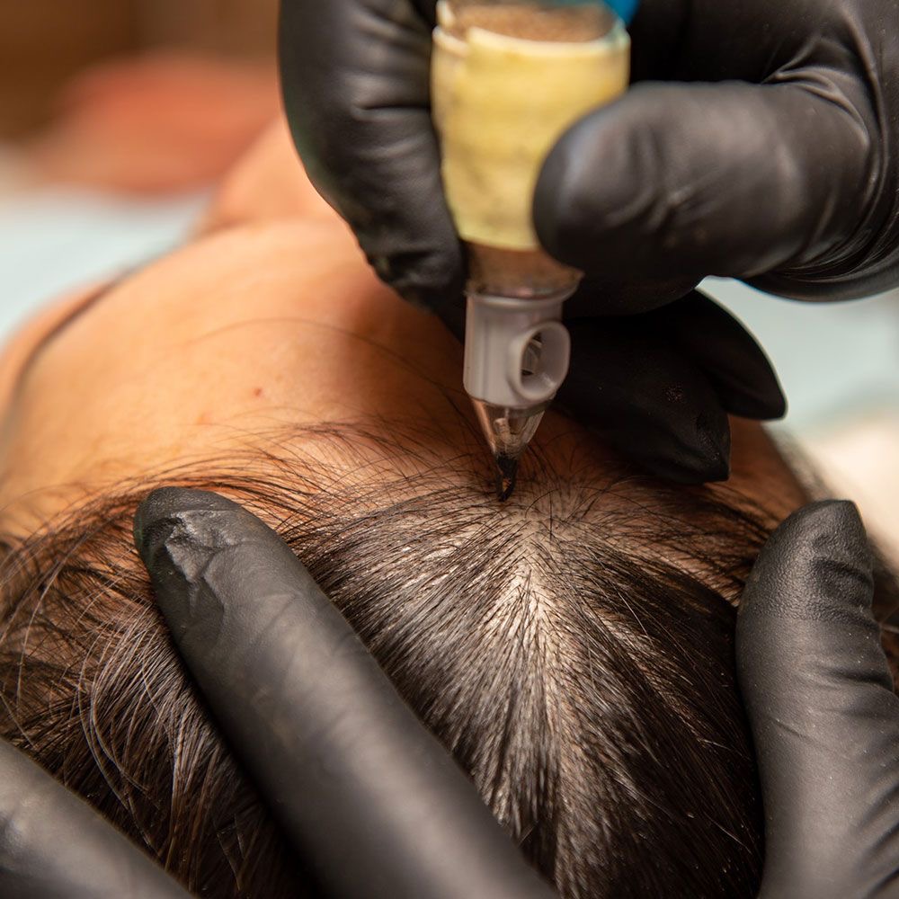 Scalp Micropigmentation