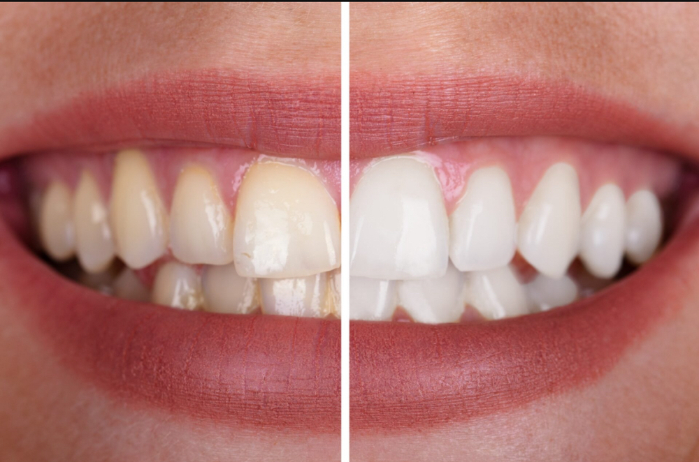Teeth Whitening at Skin Envy Myrtle Beach in Myrtle Beach, SC
