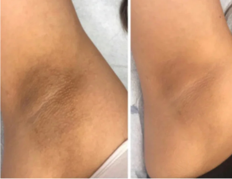 Intimate Area Brightening Treatment