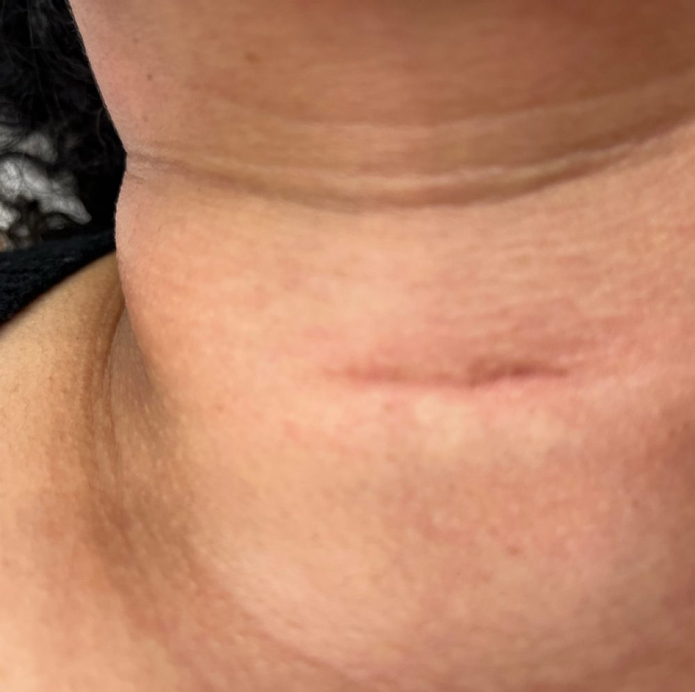 Paramedical Scars at Faces by Anissa in Dunwoody, GA