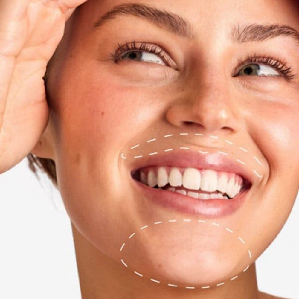 Laser Hair Removal-Upper Lip & Chin at Radiance Beauty Studio in McAllen, TX