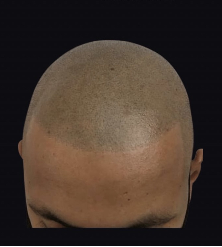 SCALP MICROPIGMENTATION