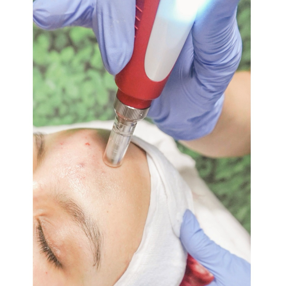 Microneedling