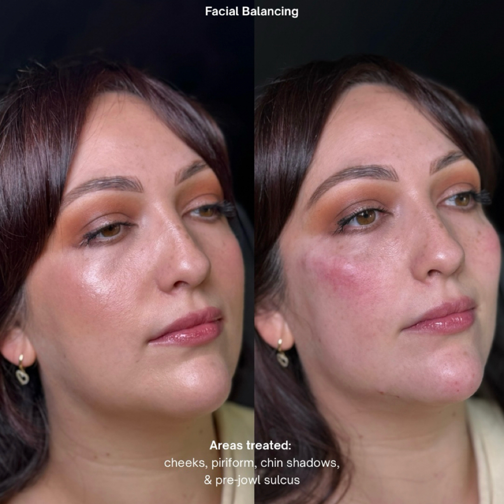 Signature Facial Balancing at Alira Aesthetics in McAllen, TX